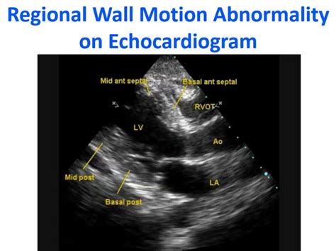 no regional wall motion abnormalities.